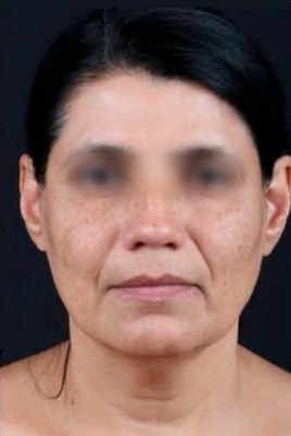 Lifting facial caso 2 — antes